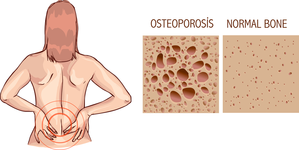 Osteoporosis, human bone anatomy. Medical illustration healthy bone and unhealthy bone